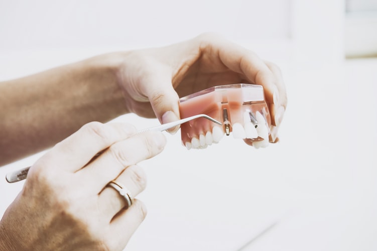 Bridge ou couronne : quelle prothèse dentaire choisir ?